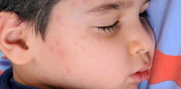 Kleiner Junge mit geschwollener Wange durch Mumpserkrankung