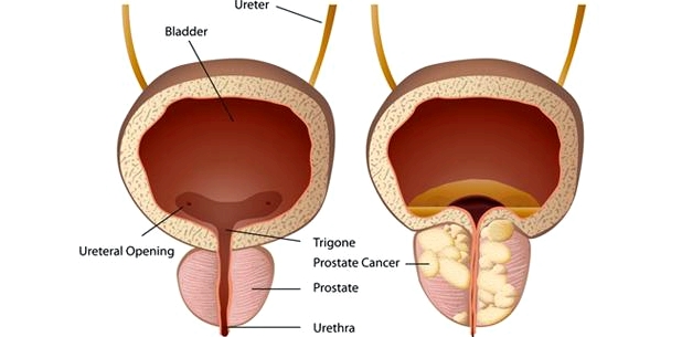 Illustration: links eine gesunde Prostata, rechts Prostatakrebs