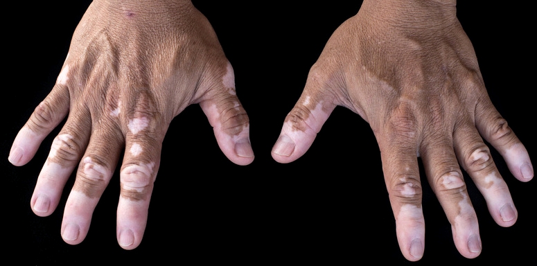 Bei Vitiligo handelt es sich um eine Pigmentstörung der Haut