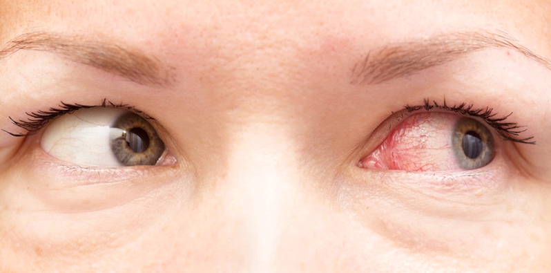 Hausstauballergiker leiden besonders nachts und morgens unter Allergie-Symptomen, wie z.B. gerötete, juckende Augen