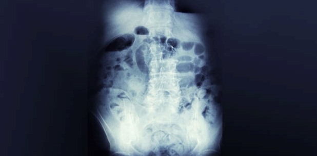 Mithilfe des Röntgen-Verfahrens lässt sich ein Darmverschluss gut diagnostizieren