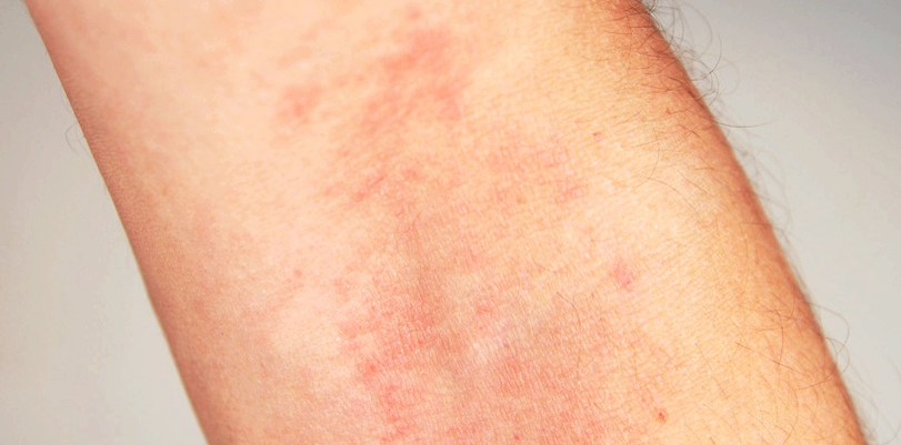 Bei einem leichten Zinkmangel zählen entzündliche Hautreaktionen zu den typischen Beschwerden