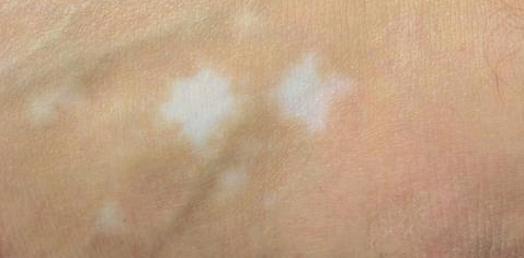 Bei der Autoimmunerkrankung Vitiligo hat die Haut stellenweise zu wenig Pigmente, statt dunkler entstehen helle Flecken