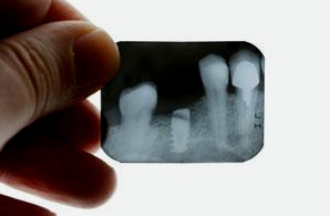 Röntgen hilft dem Zahnarzt bei der Diagnose von Zahnschmerzen