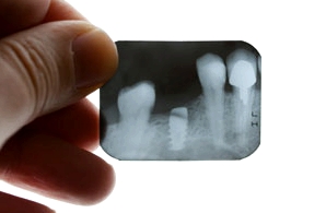 Röntgenaufnahme der Zähne hilft dem Zahnarzt bei der Diagnose von Zahnschmerzen