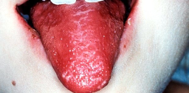 Die sogenannte Himbeerzunge ist ein typisches Symptom für Scharlach